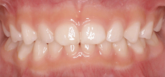 閉鎖歯列
